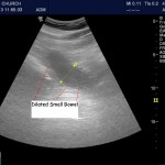 Small Bowel Obstruction is not hard to find with POCUS:  Lloyd Gordon makes his case