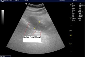 Small Bowel Obstruction is not hard to find with POCUS:  Lloyd Gordon makes his case