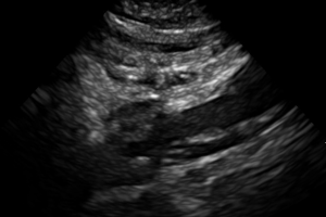 POCUS for Aortic Dissection – A Case