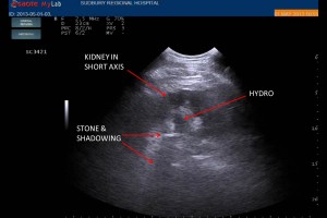 Faster, radiation-free approach to Renal Colic with POCUS/EDE