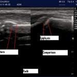 Don’t be subtle: Use POCUS for hard to see fractures