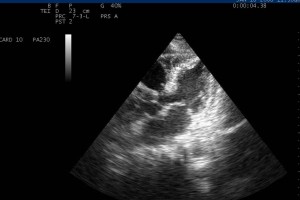 Hypothermic Heart on POCUS