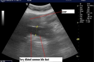 Common Bile Duct Measurements: Not very useful for emergency physicians