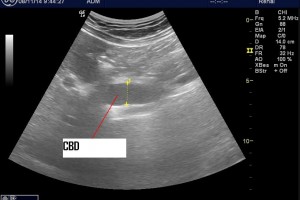 Common Bile Duct: How useful is it for us to image?