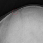 Ultrasound beats Xray for skull fracture