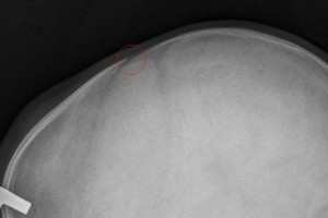 Ultrasound beats Xray for skull fracture