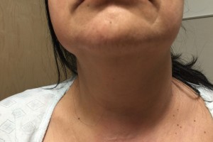 Huge save in a patient with neck swelling