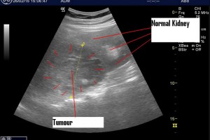 The Power of POCUS with clinical change