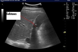 How often do you use POCUS?
