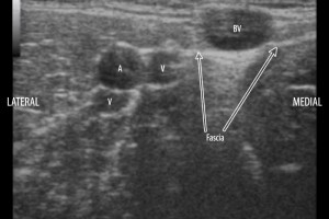 Peripheral IV placement with POCUS