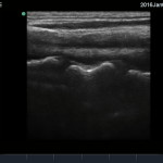 Have you ever wondered about using POCUS for C-Spine fractures?