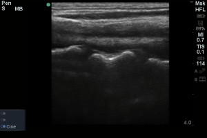 Have you ever wondered about using POCUS for C-Spine fractures?