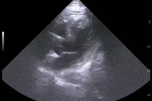 Using POCUS for decision-making in CP R/O ACS cases