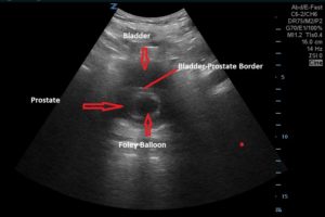 Avoid the poor man’s TURP with a Foley by using POCUS