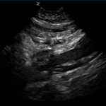 POCUS for Aortic Dissection – A Case