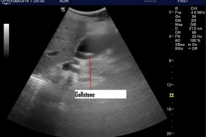 POCUS and recurrent abdominal pain in the elderly