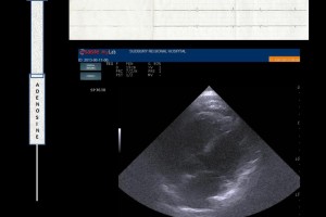 Does the heart REALLY stop when you give Adenosine to an SVT patient – find out with POCUS!
