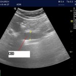 Common Bile Duct: How useful is it for us to image?