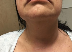 Very mild swelling of the left neck and  cheek