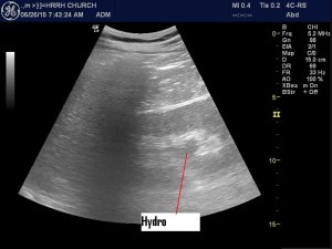 First Hydronephrosis patient