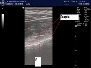 Right scapular fracture