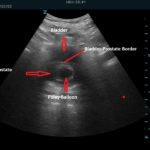 Avoid the poor man’s TURP with a Foley by using POCUS