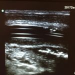 Foreign bodies in genitalia – Time for POCUS!
